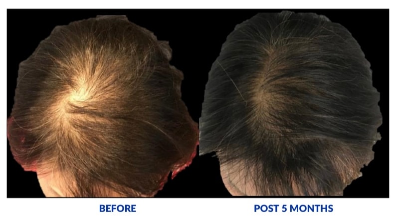 Hair loss before and after 5 months of treatment — dramatic regrowth at the crown