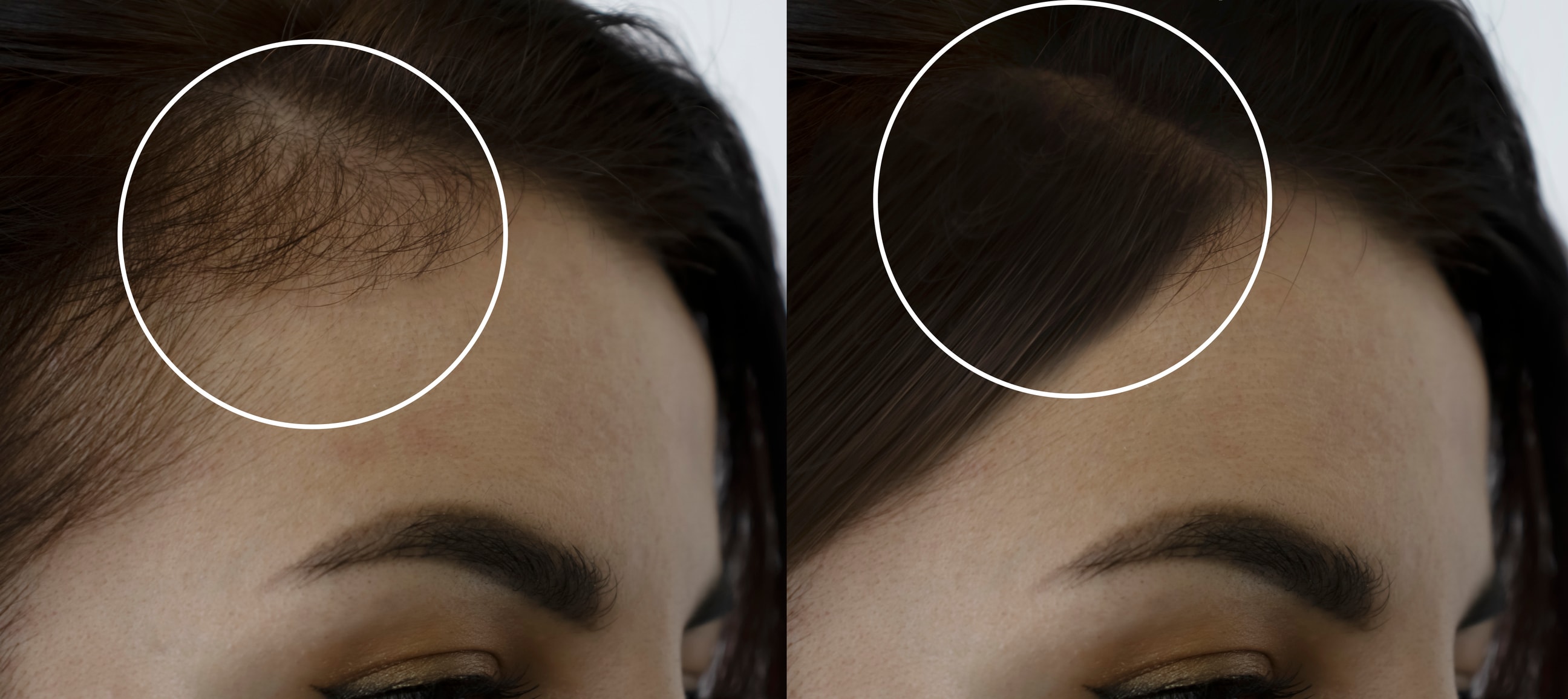 Female hair regrowth before and after — fuller hairline at the temples