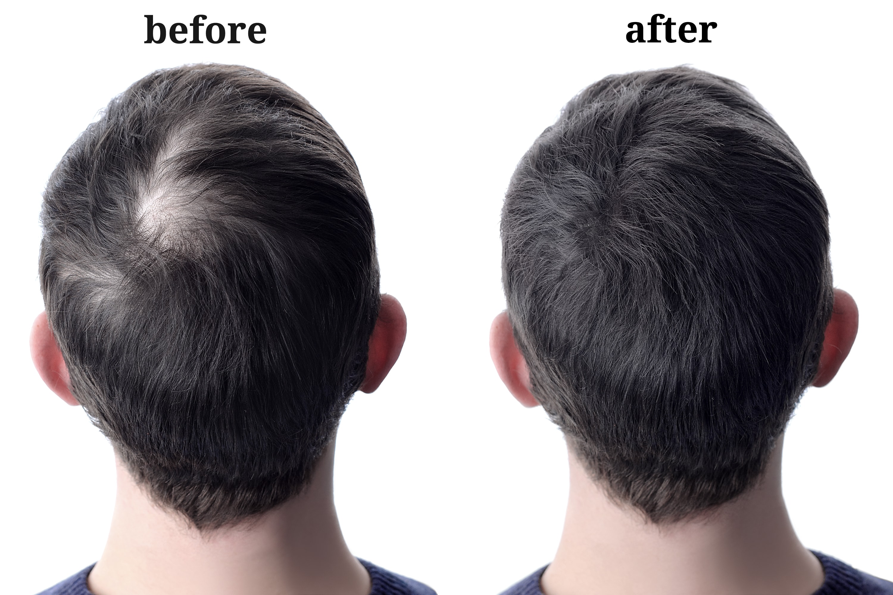 Male hair regrowth before and after — fuller crown and reduced thinning at the top