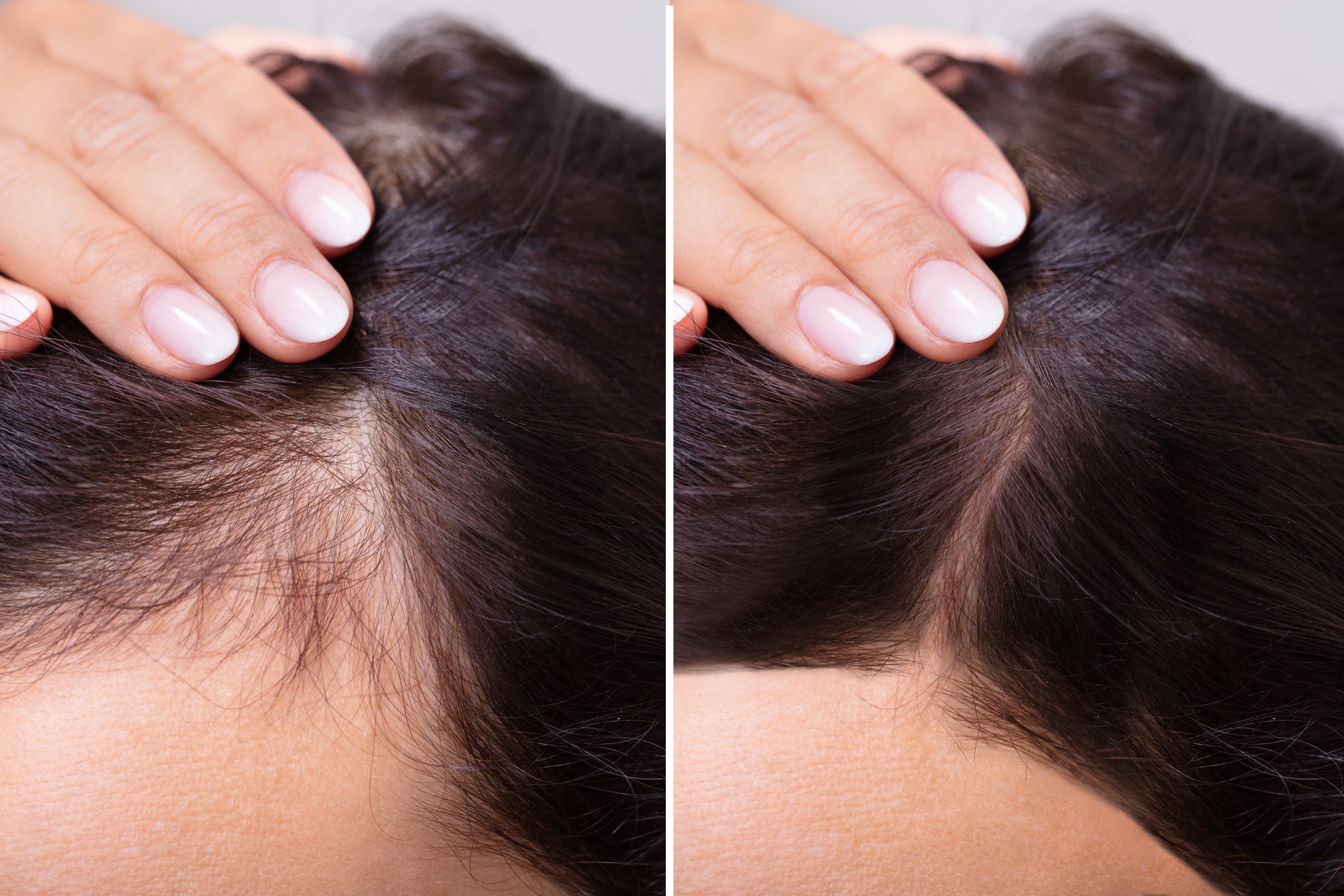 Female hair regrowth before and after — fuller hairline at the part