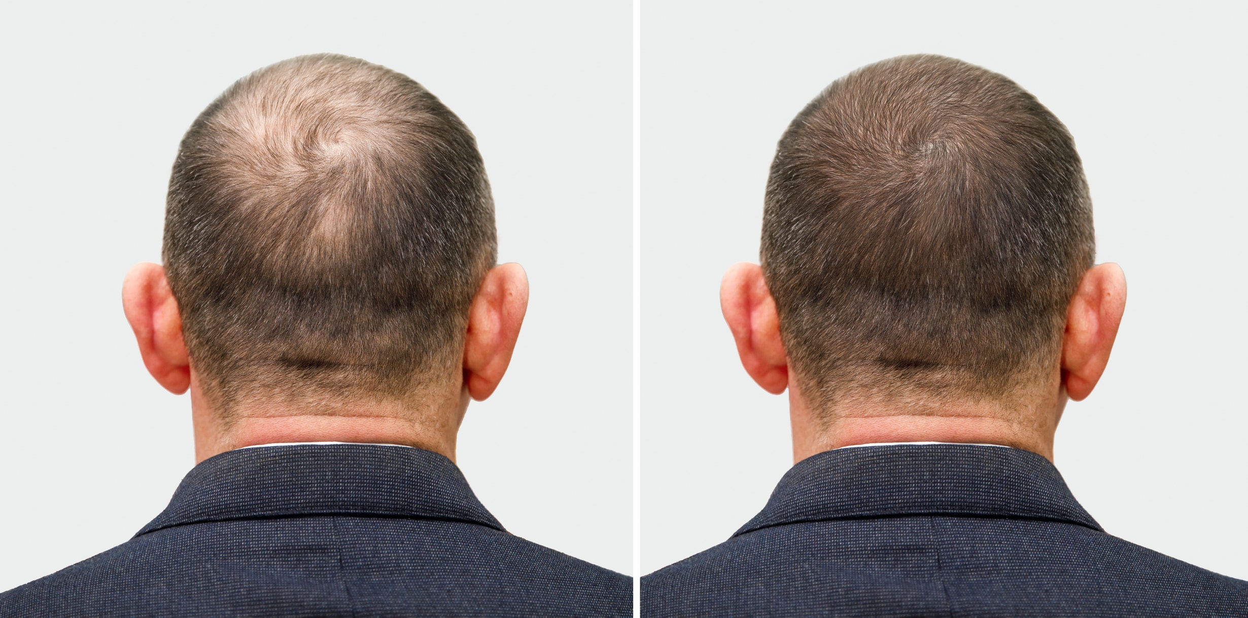 Male hair regrowth before and after — dramatic crown regrowth from behind