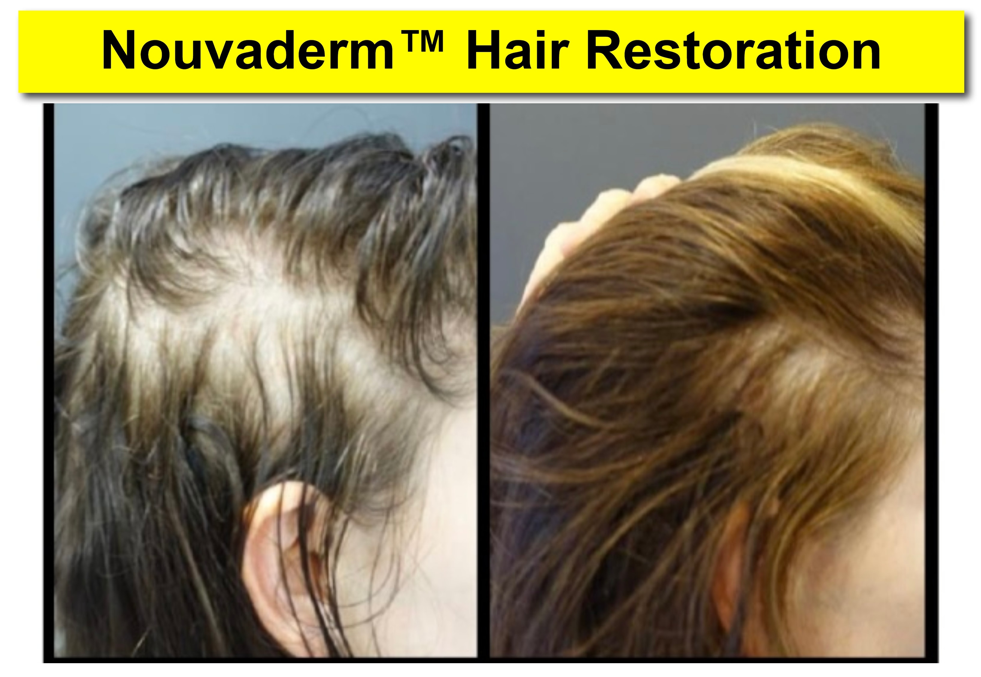 NOUVADerm™ Hair Restoration before and after — dramatic hair regrowth results