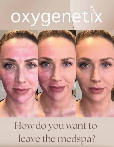Oxygenetix before and after — How do you want to leave the medspa?